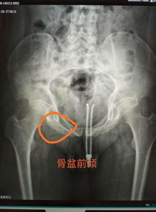 骨康11.png