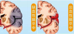卒中1.png